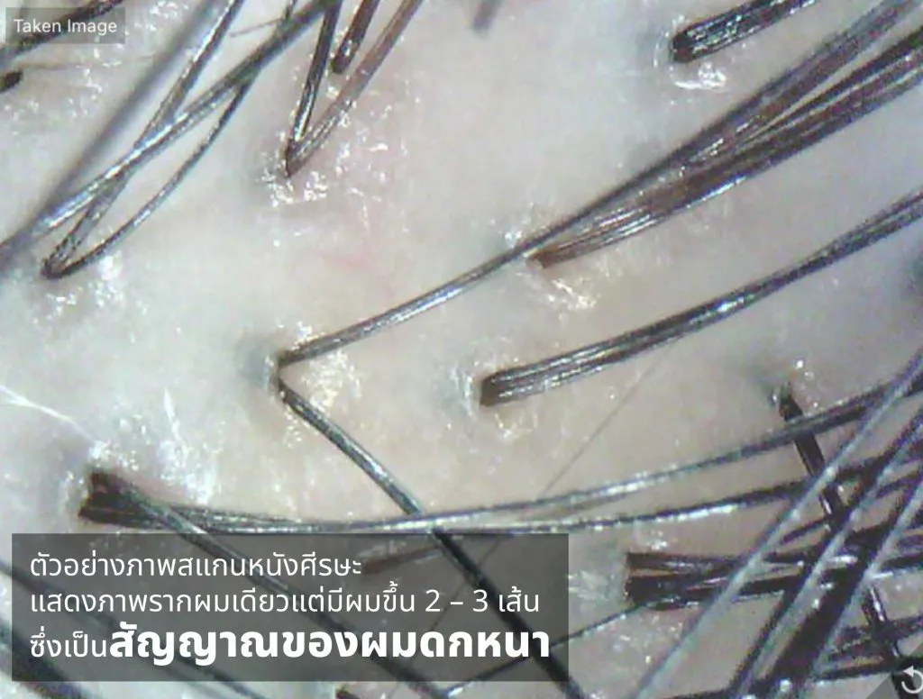Scan — one follicle with multiple strands