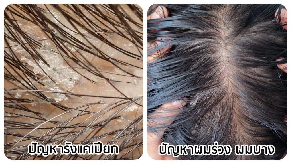 AloEx — oily hair leads to dandruff and shedding