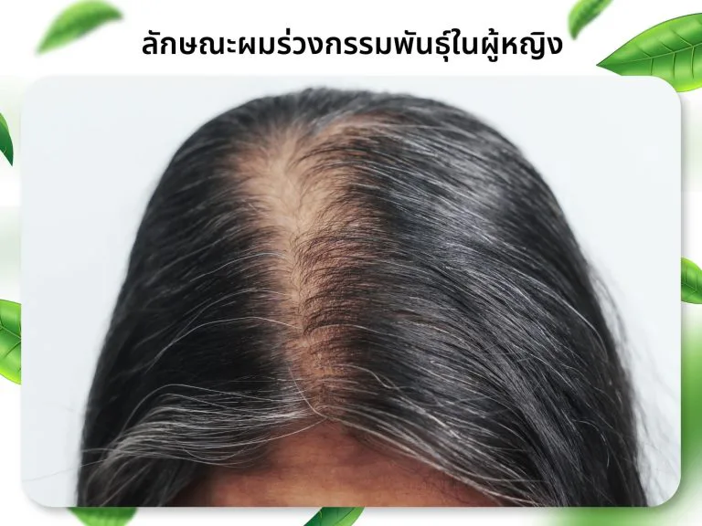 女性遗传性脱发