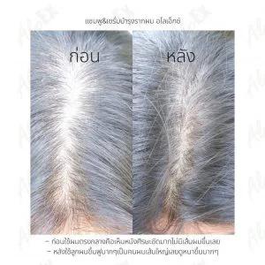 သုံးပြီးနောက် ဆံပင်အသစ်တွေ အများကြီး ထူထူပူပူ ပေါက်လာတယ် — မူလဆံပင်ကြမ်းတဲ့လူဆိုတော့ ပိုထူလာတာ မြင်ရတယ်