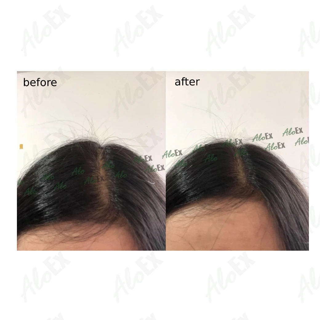 รีวิวก่อนใช้-หลังใช้ ผลิตภัณฑ์ AloEx