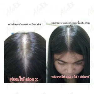 ဦးရေပြားဆီဆိုးသိပ်တာ သက်သာပြီး ဆံပင်အသစ်လေးတွေ ပေါက်လာတယ်