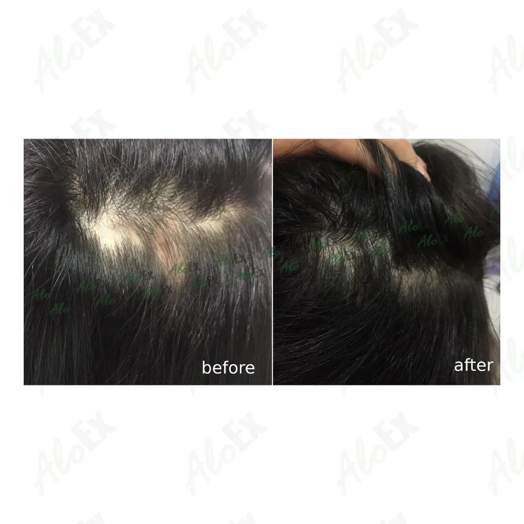 รีวิวก่อนใช้-หลังใช้ ผลิตภัณฑ์ AloEx