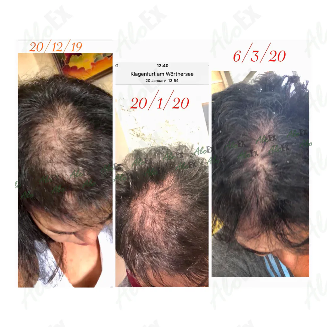 รีวิวก่อนใช้-หลังใช้ ผลิตภัณฑ์ AloEx