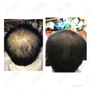 Before & After Reviews — AloEx Products