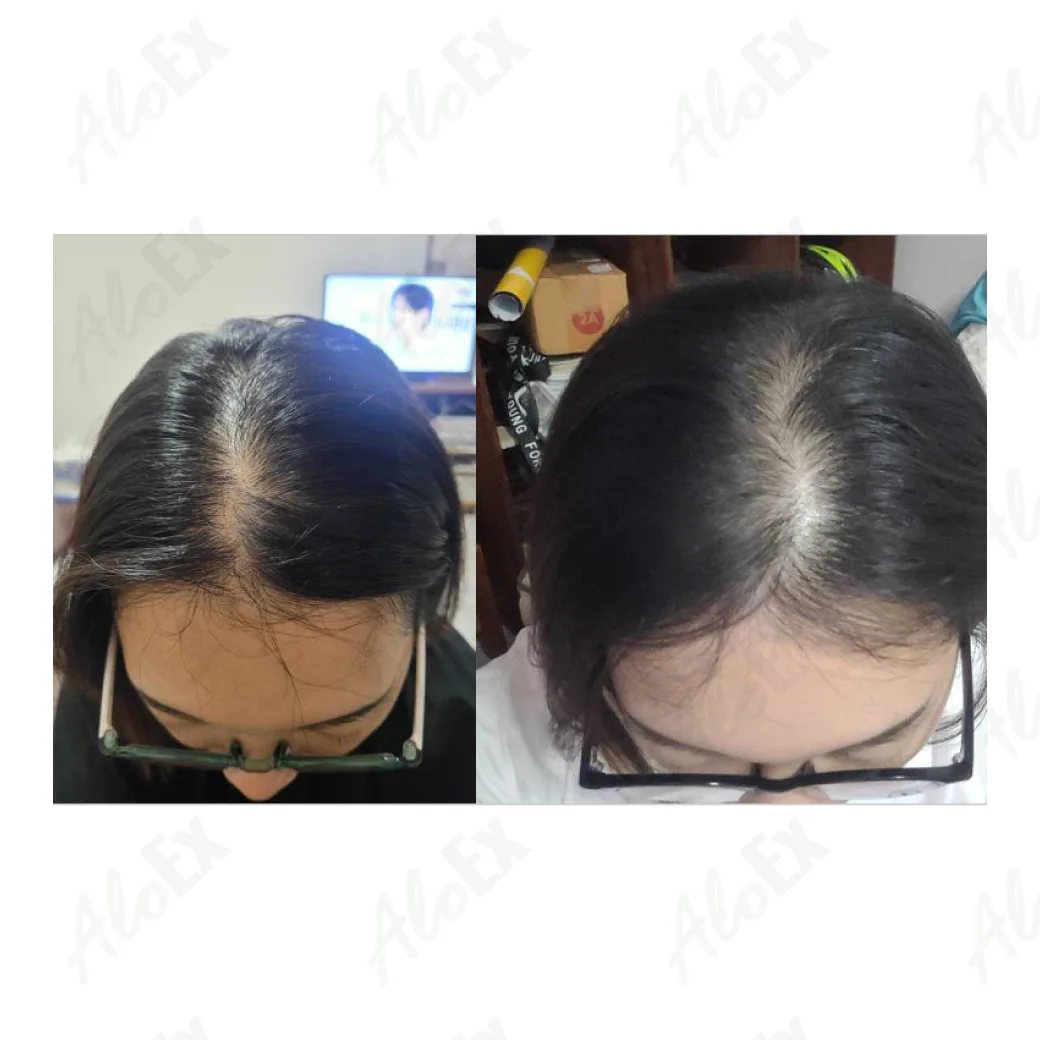 รีวิวก่อนใช้-หลังใช้ ผลิตภัณฑ์ AloEx
