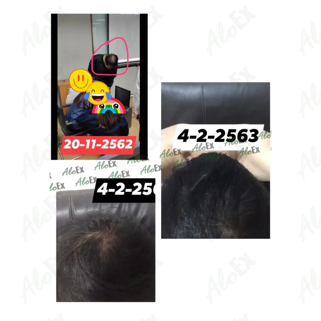 รีวิวก่อนใช้-หลังใช้ ผลิตภัณฑ์ AloEx
