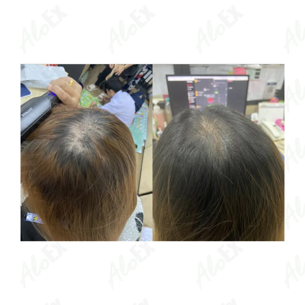 รีวิวก่อนใช้-หลังใช้ ผลิตภัณฑ์ AloEx