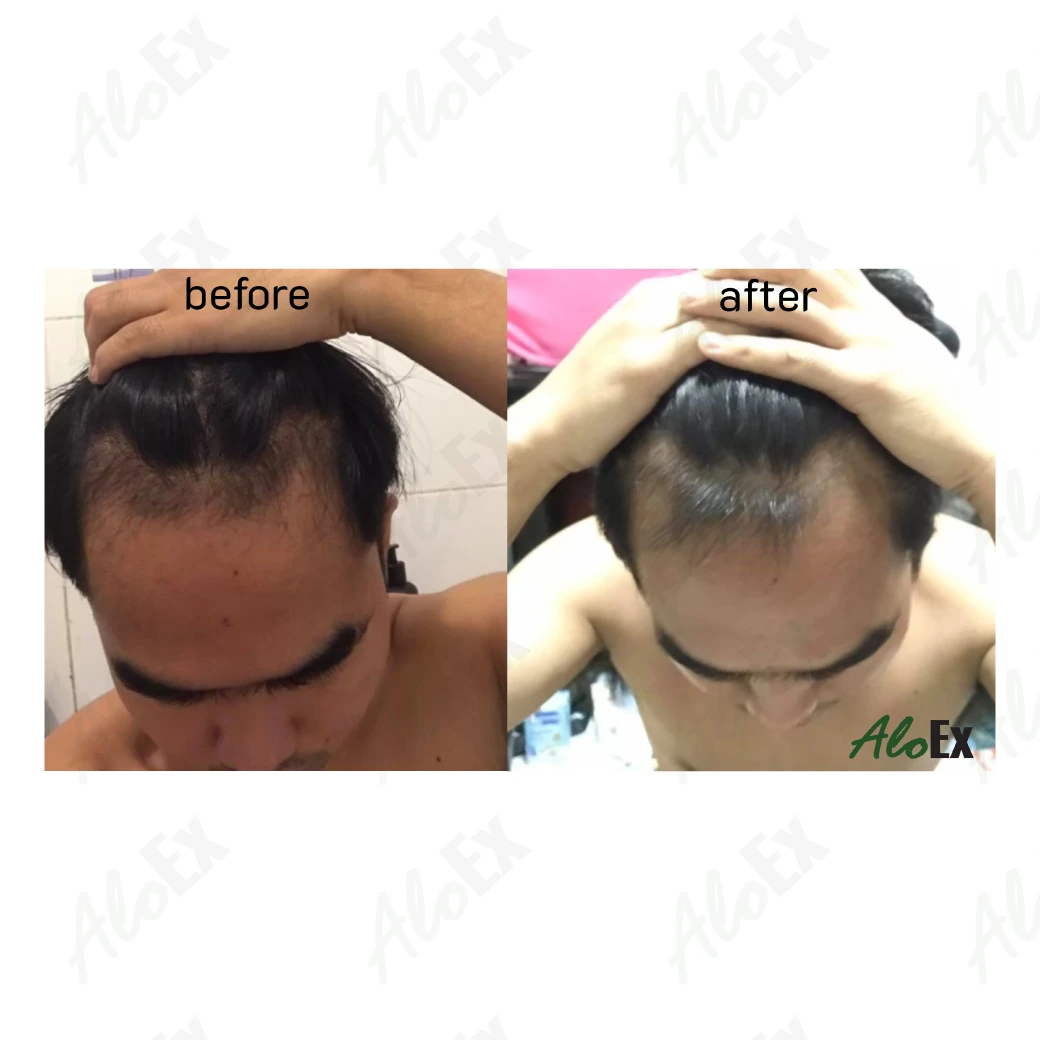 รีวิวก่อนใช้-หลังใช้ ผลิตภัณฑ์ AloEx