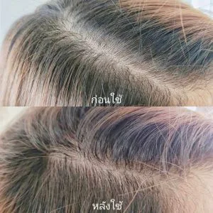 ဒီ AloEx ဆီးရမ်က ဆံပင်ကျွတ်ခြင်းကို အရမ်းကောင်းကောင်း လျှော့ချပေးတယ်။