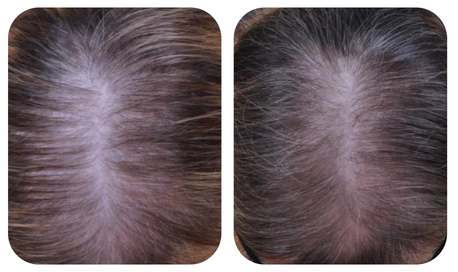 เปรียบเทียบหนังศีรษะก่อนและหลังใช้ AloEx Organic Intensive Hair Serum ภาพที่ 1